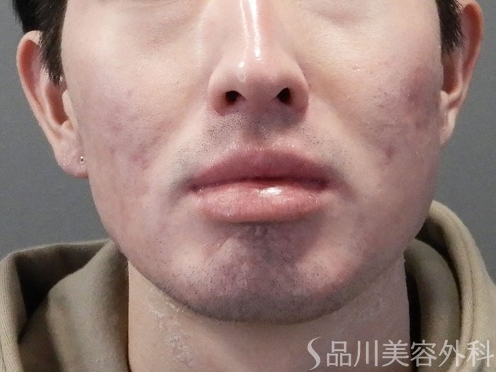 症例NO.73146のAFTER写真