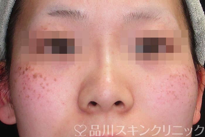 症例NO.74214のAFTER写真
