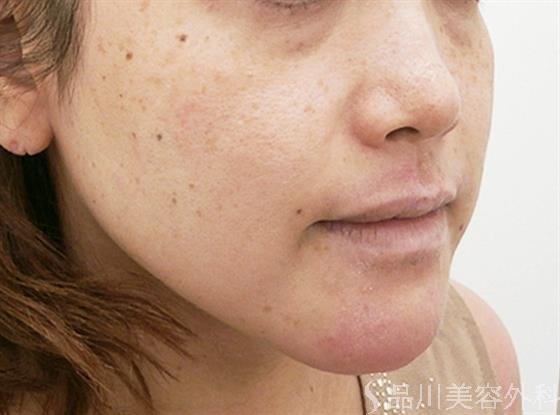症例NO.21899のBEFORE写真