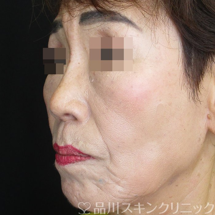 症例NO.74230のAFTER写真