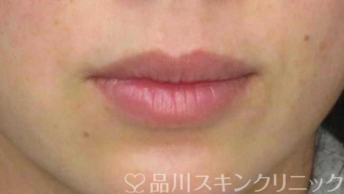 症例NO.65533のBEFORE写真