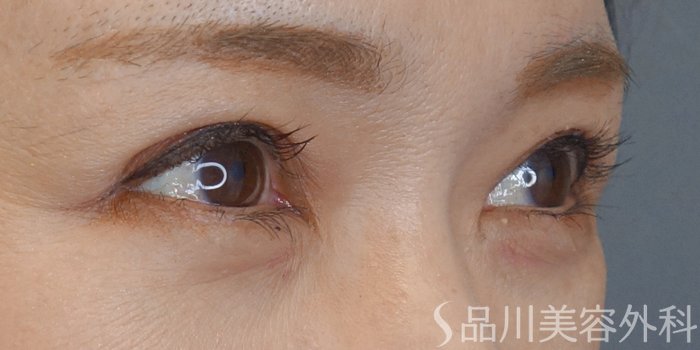 症例NO.72104のAFTER写真