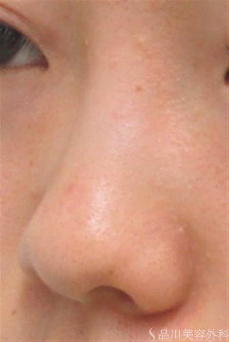 症例NO.22125のBEFORE写真