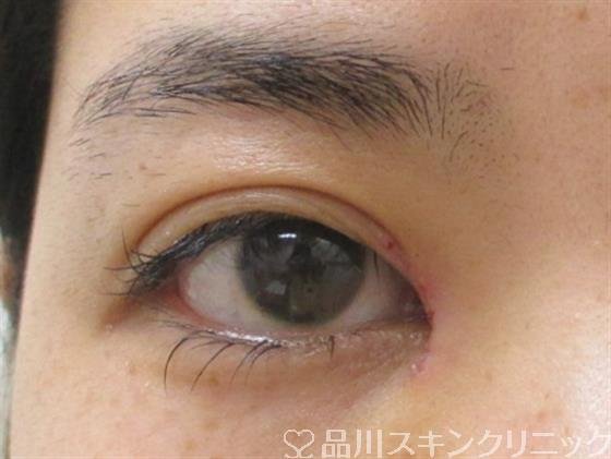 症例NO.26835のAFTER写真