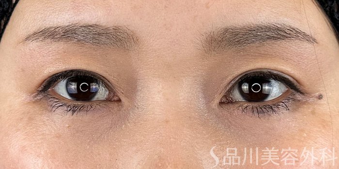 症例NO.64940のAFTER写真