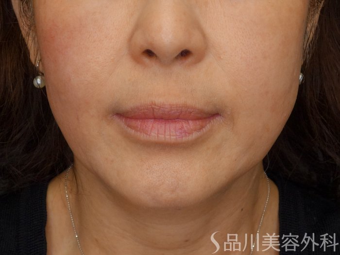 症例NO.70195のBEFORE写真