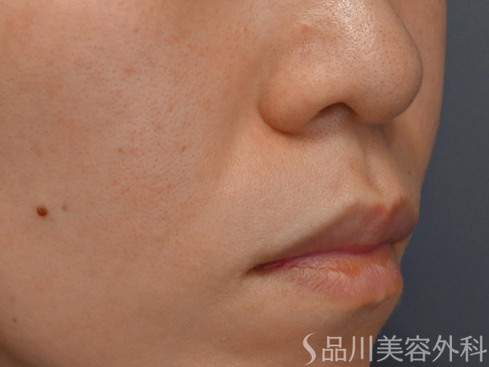 症例NO.68079のBEFORE写真