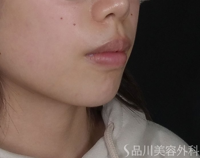 症例NO.69442のBEFORE写真