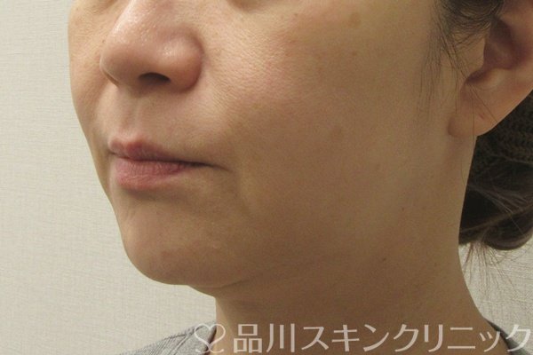 症例NO.74556のBEFORE写真