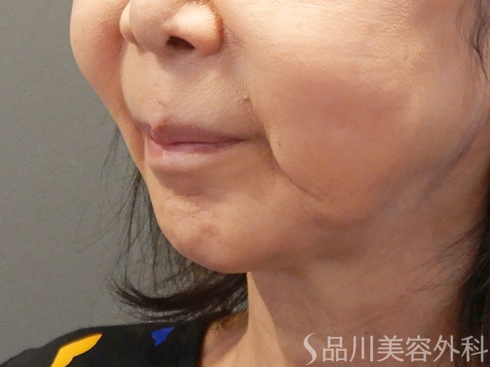 症例NO.71623のBEFORE写真