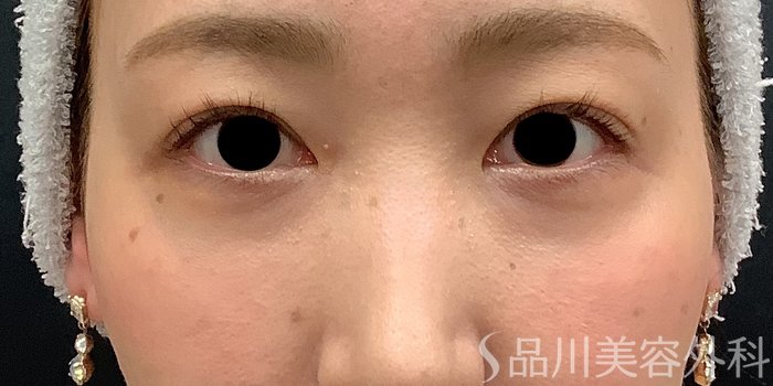 症例NO.69662のAFTER写真