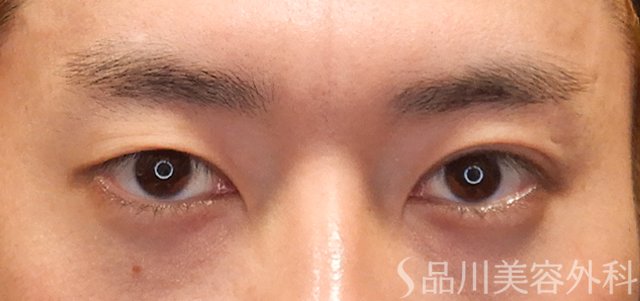 症例NO.72151のBEFORE写真