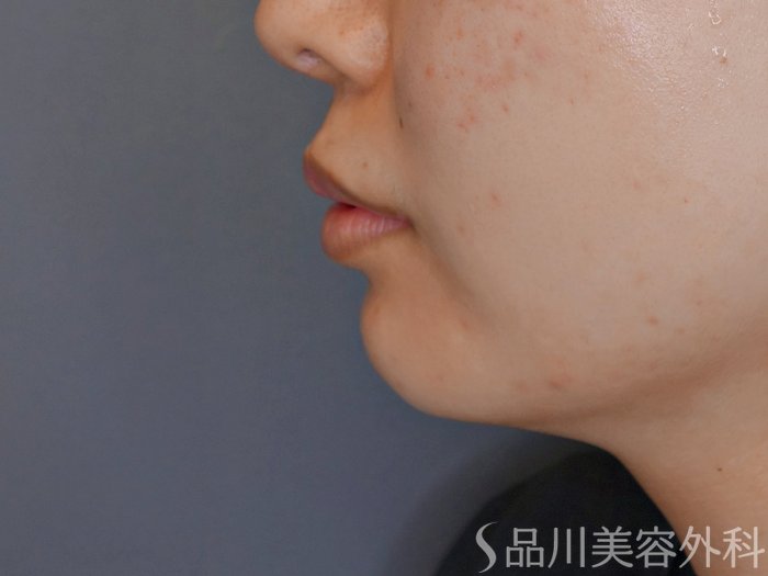 症例NO.67942のBEFORE写真