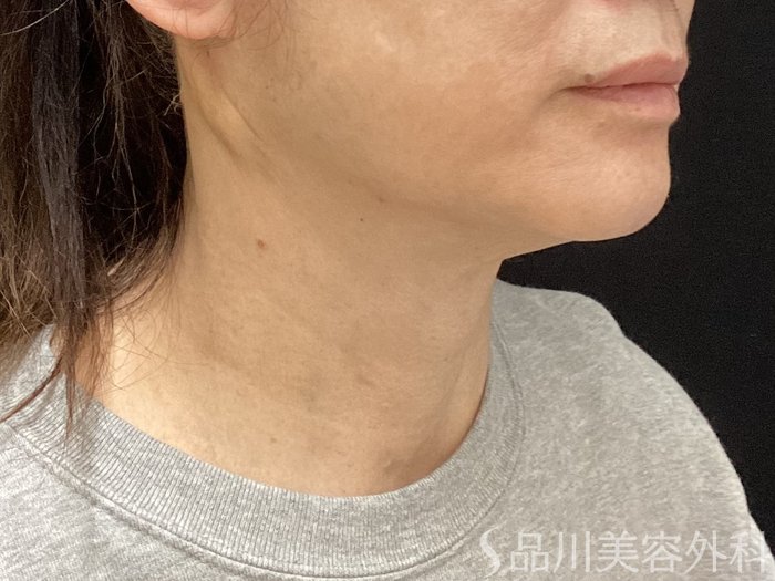 症例NO.69582のAFTER写真