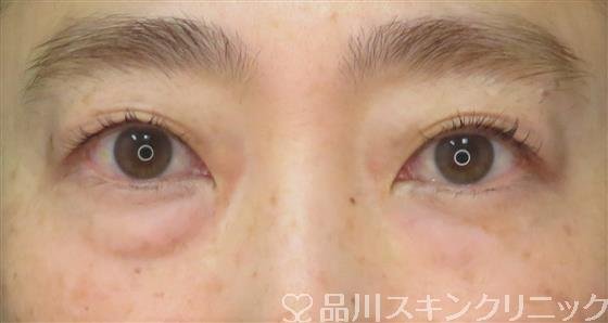 症例NO.58046のBEFORE写真