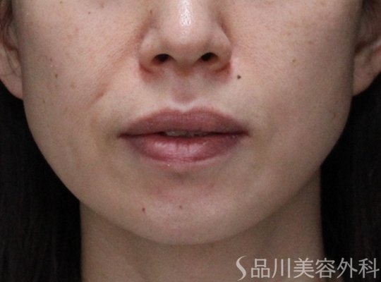 症例NO.73913のBEFORE写真