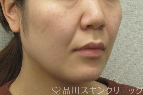 症例NO.74461のBEFORE写真