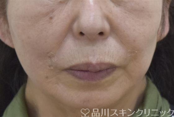 症例NO.52946のAFTER写真