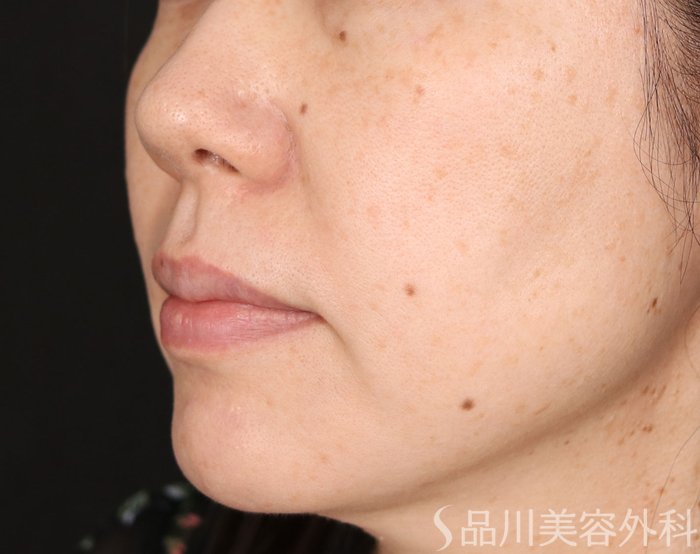 症例NO.70945のBEFORE写真
