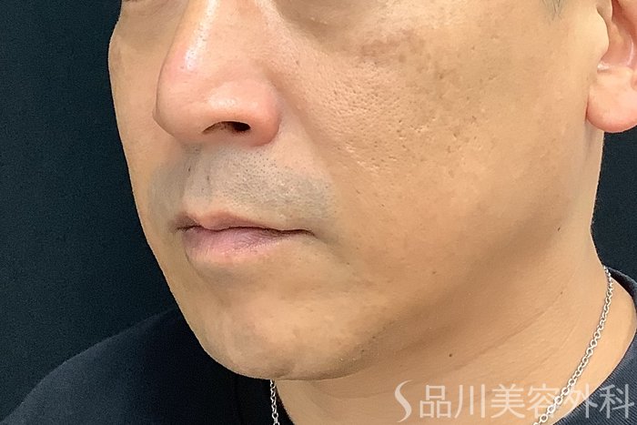 症例NO.71214のBEFORE写真