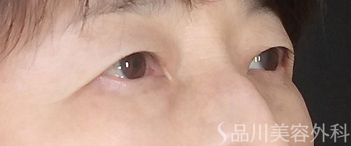 症例NO.73368のBEFORE写真