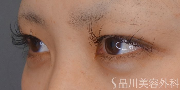 症例NO.69308のBEFORE写真