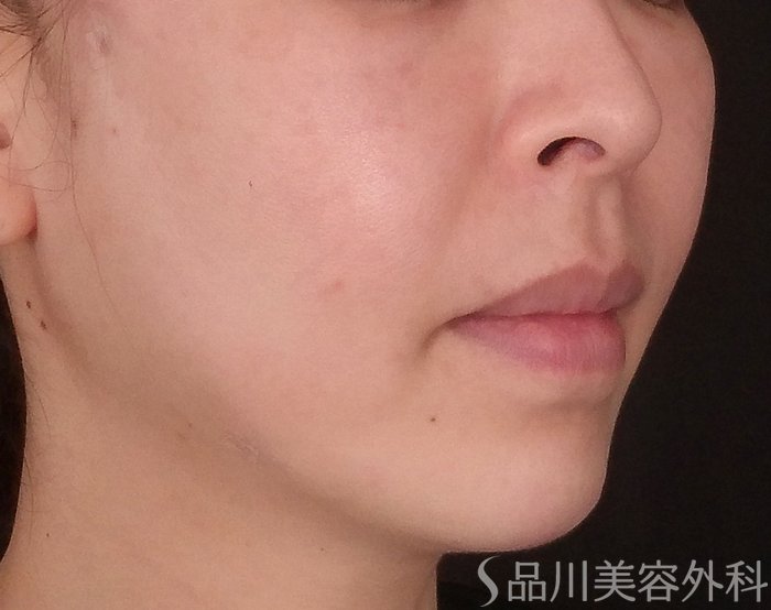 症例NO.69794のAFTER写真