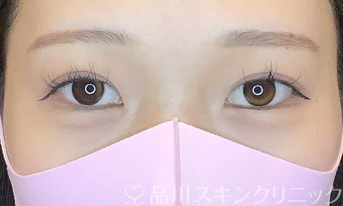 症例NO.70376のAFTER写真