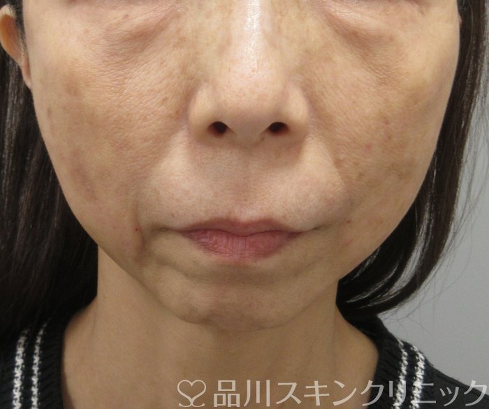 症例NO.74273のAFTER写真