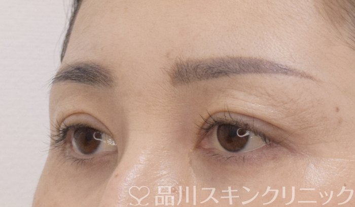 症例NO.75017のAFTER写真