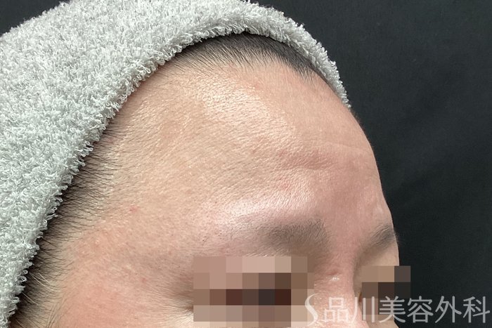 症例NO.67802のBEFORE写真