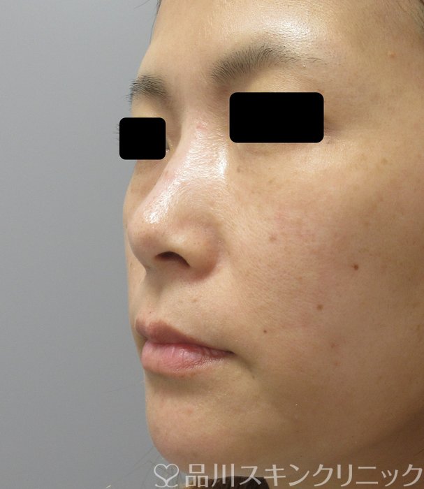 症例NO.73518のBEFORE写真