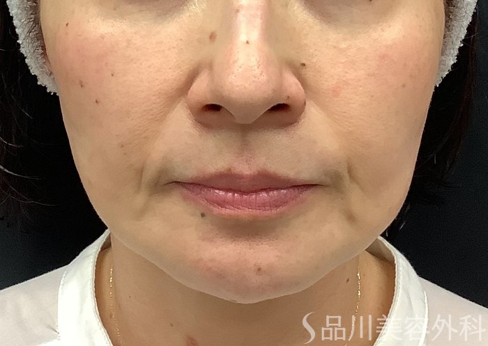 症例NO.75049のBEFORE写真