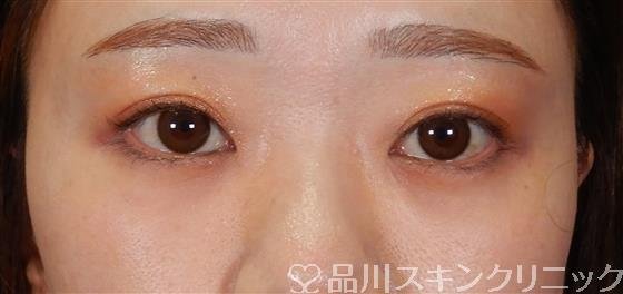 症例NO.60997のAFTER写真