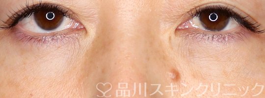 症例NO.74429のAFTER写真