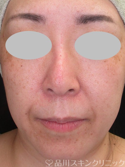 症例NO.73415のAFTER写真