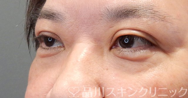 症例NO.68463のBEFORE写真