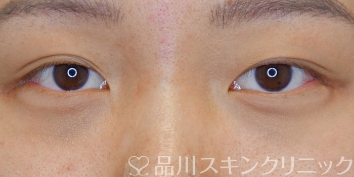 症例NO.72572のAFTER写真