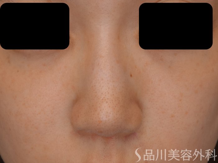 症例NO.71204のAFTER写真