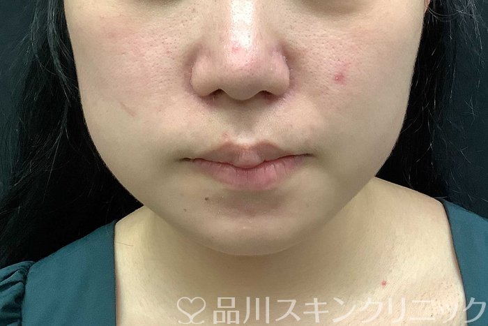 症例NO.69778のBEFORE写真