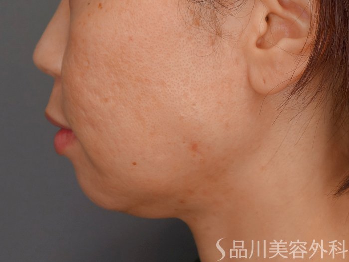 症例NO.73246のBEFORE写真