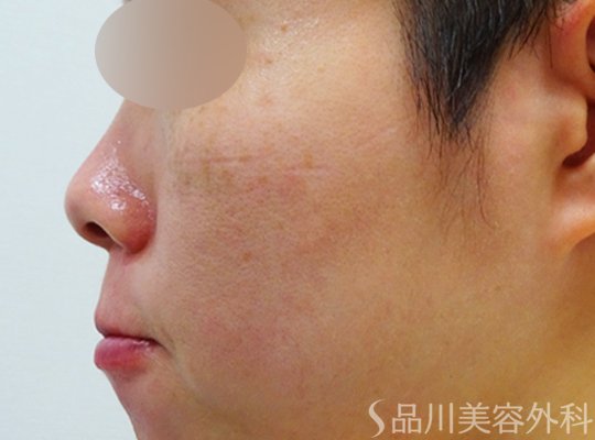 症例NO.71189のAFTER写真