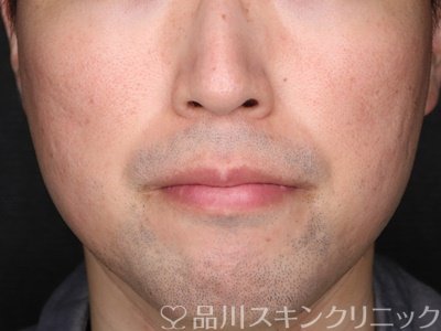 症例NO.75085のAFTER写真