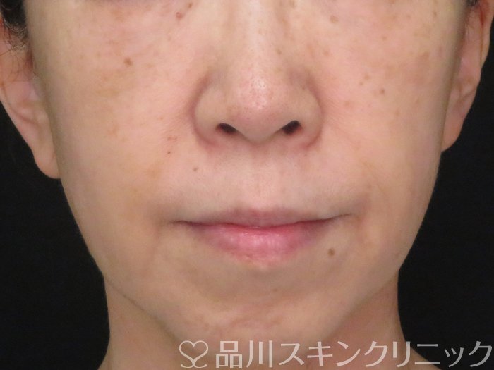 症例NO.70731のBEFORE写真