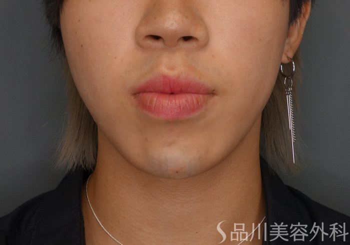 症例NO.75358のAFTER写真