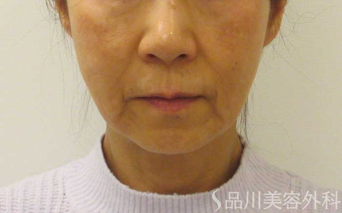 症例NO.73409のBEFORE写真