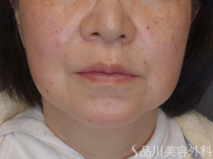 症例NO.69979のBEFORE写真