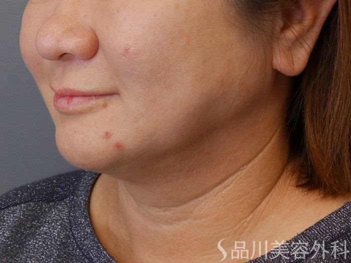 症例NO.72816のBEFORE写真