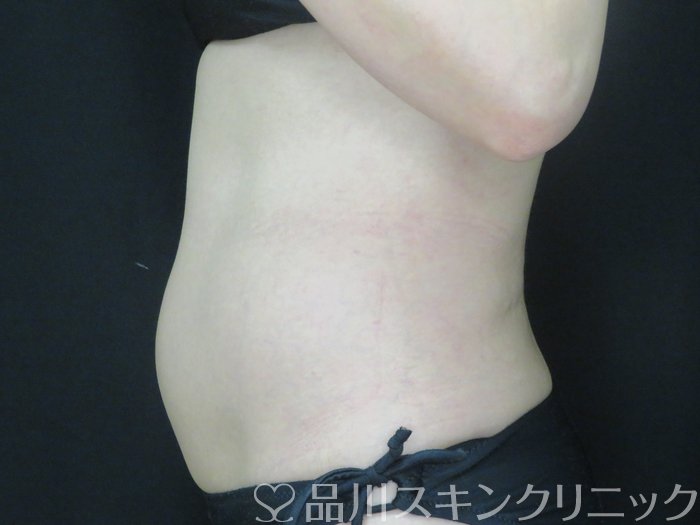 症例NO.70144のBEFORE写真