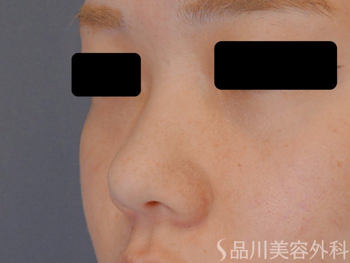 症例NO.72184のBEFORE写真